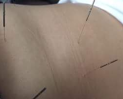 目黒区での出張鍼灸施術の様子（女性の腰痛）