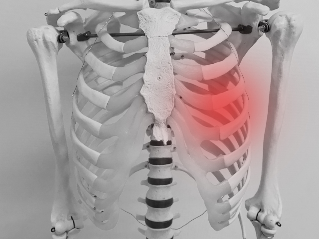 肋間神経痛のイメージ図