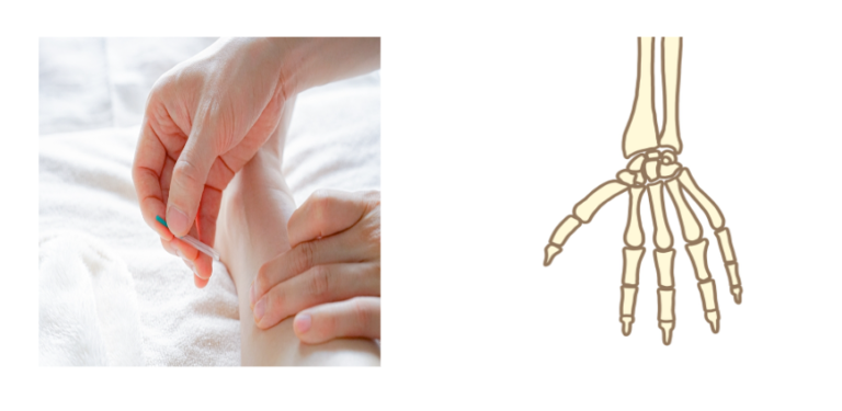 鍼は筋肉に刺すより骨に当てたほうが良いと思う